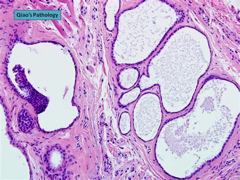 Flickriver: Photoset 'Apocrine Hidrocystoma (Moll's gland cyst) of the Eyelid' by Qiao's ...