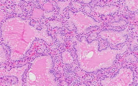 Histology Of Graves Disease - My Endo Consult