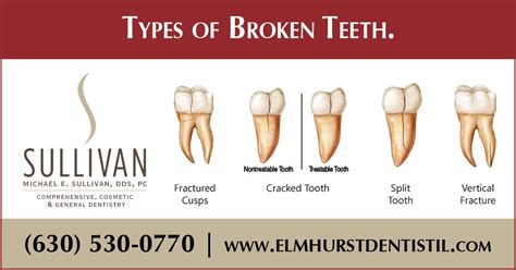 Tooth Fracture Classification | My XXX Hot Girl