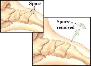 Foot Surgery: Bone Spurs | Saint Luke's Health System