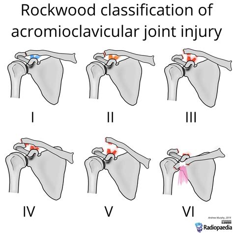 rockwood-classification-of-acromioclavicular-joint-injury - ALiEM