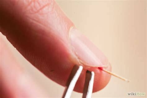 How to Remove a Splinter Under Your Fingernail: 12 Steps