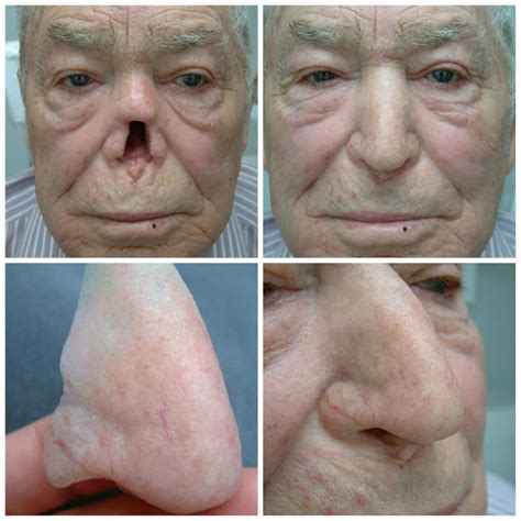 Nose Photo Gallery – Medical Art Prosthetics