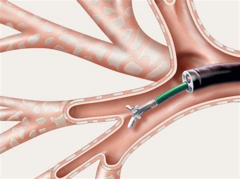 flexible-bronchoscopy-and-biopsy-of-lung - Pediatric Pulmonologists