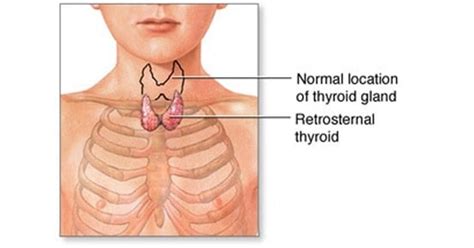 Retrosternal Goiter - New