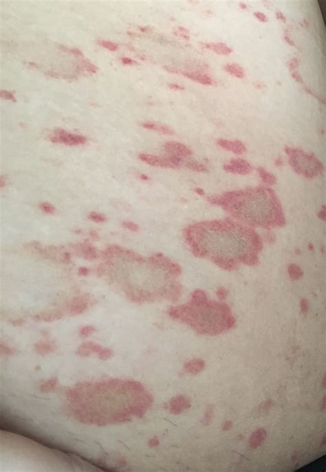 I have a rash, thought it might be some type of fungus, doc says ringworm? - Ask a doctor free ...