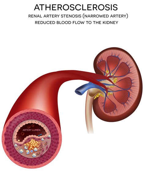 RENAL ARTERY STENOSIS - MIVA Medical