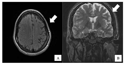 Cureus | Case Report: Rasmussen’s Encephalitis Treated Successfully ...