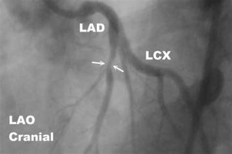 Recanalised significant LAD stenosis just after the first diagonal ...