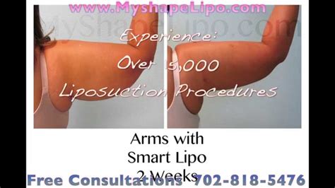 liposuction arms before and after - Liposuction - Vaser Lipo