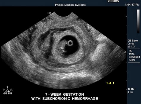 Fetal ultrasound with subchorionic hemorrhage at seven weeks. Imaged ...