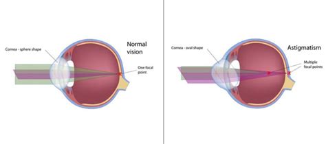 Astigmatism – Symptoms and Care | Casa Grande Eye Care