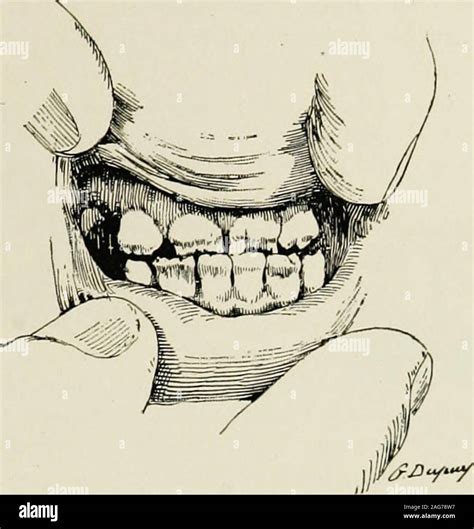 Hutchinsons teeth hi-res stock photography and images - Alamy