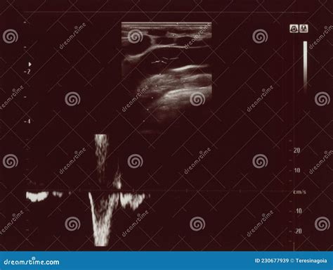 Diagnostic Sonography Of Abdomen Royalty-Free Stock Image ...