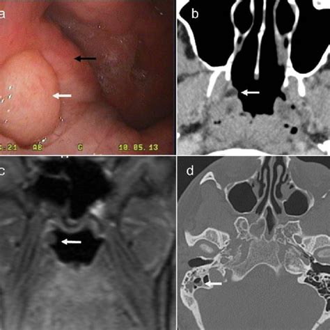 Right ear – Anteroinferior perforation with two myringosclerosis... | Download Scientific Diagram