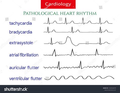 3,562 Ecg arrhythmia Images, Stock Photos & Vectors | Shutterstock