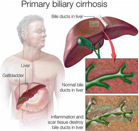 Primary biliary cholangitis causes, symptoms, life expectancy, diet & treatment