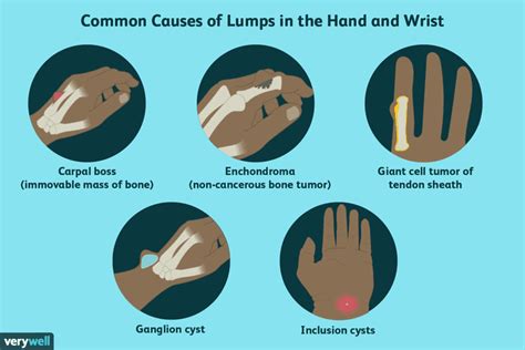 Causes of Lumps and Bumps on the Hands and Wrists