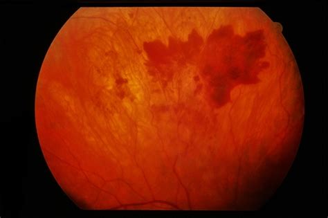 Eales Disease - Retina Image Bank