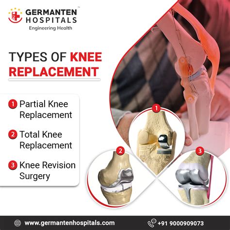 Pin on Best Knee Replacement Surgery in Hyderabad