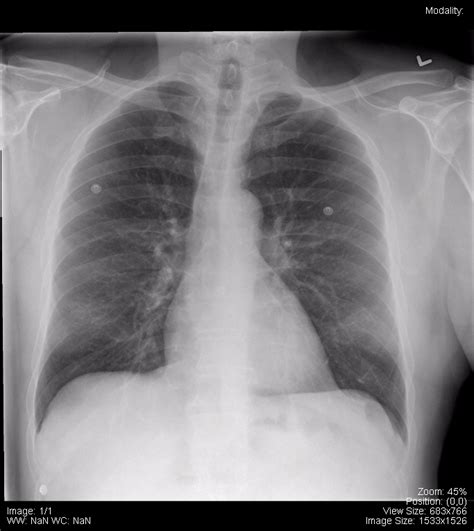 Chest – Undergraduate Diagnostic Imaging Fundamentals