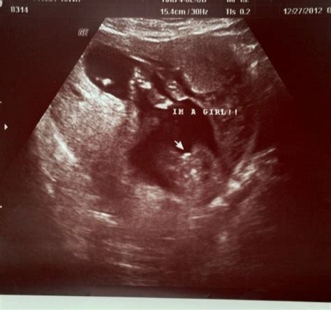 How to Make a Smile: Gender Reveal Ultrasound