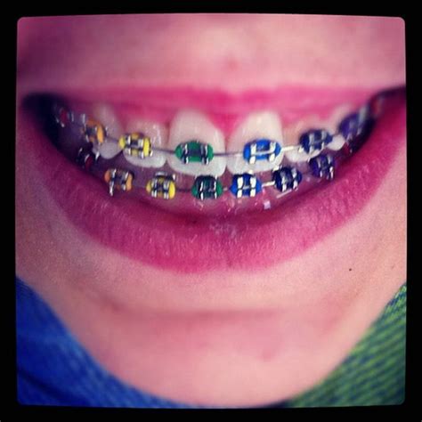 Braces Cool Color Ideas - best discount