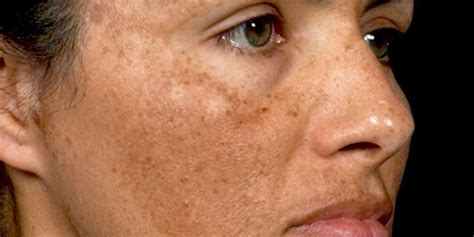 Hyperpigmentation causes, hyperpigmentation treatment