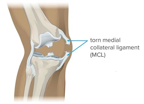 MCL tear: Symptoms, diagnosis, and treatment