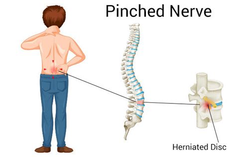 Pinched Nerve Physical Therapy Chiropractic Chart | ubicaciondepersonas ...