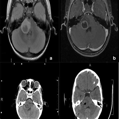 Patient I.D.L. a FLAIR MRI axial view showing a right cerebellar... | Download Scientific Diagram