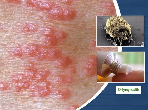 What Is Scabies? Learn About Its Causes, Symptoms And Treatment ...