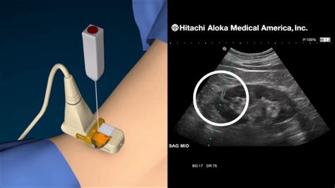 Office based Ultrasound Guided Percutaneous Renal Mass Biopsy - YouTube