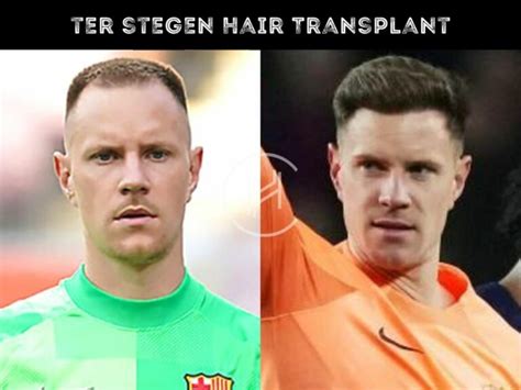 Ter Stegen Hair Transplant - Hair Loss & Technical Analysis