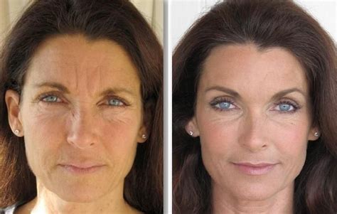 Facial Aerobics Exercises For Men And Women: Here Is How One Can Decrease Smile Furrows And ...