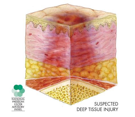 Deep Tissue Injury: What the Eye Can’t See | Wound care expert witness