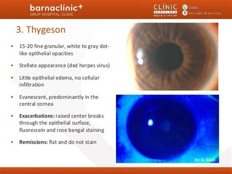 Noninfectious keratitis barnaclinic