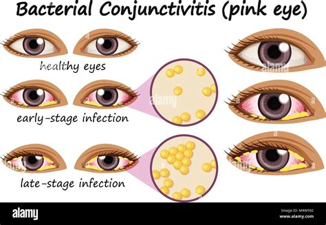 Bacterial Conjunctivitis (Pink Eye): Treatment And More, 57% OFF