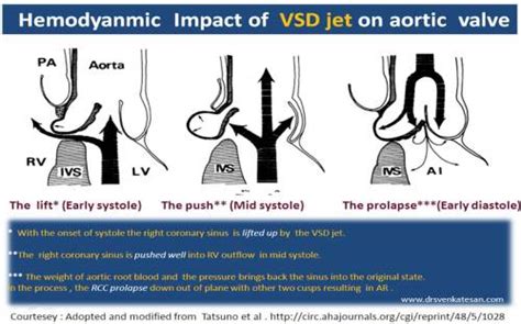 supracristal vsd | Dr.S.Venkatesan MD