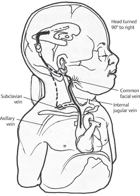 What Is A Ventriculoperitoneal Shunt