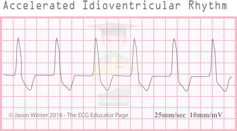 ECG Educator Blog : Ventricular Rhythms