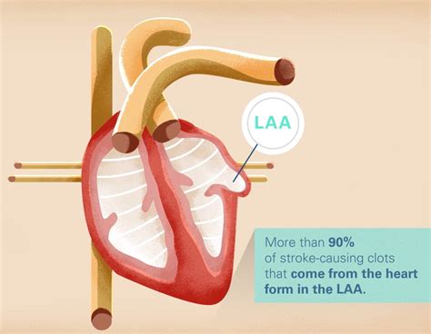 WATCHMAN Left Atrial Appendage Closure Device | Advanced Cardiovascular Specialists