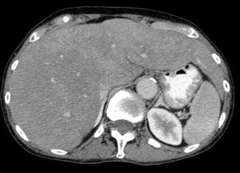 The CT scan – reduced hepatic perfusion in enlarged liver after... | Download Scientific Diagram