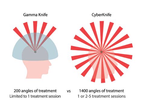 CyberKnife vs Gamma Knife - Epic Care CyberKnife