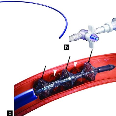 Picture illustration of the INARI FlowTriever and its components. e 20 ...