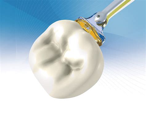 Griptab - Triodent | March 2010 | Inside Dentistry