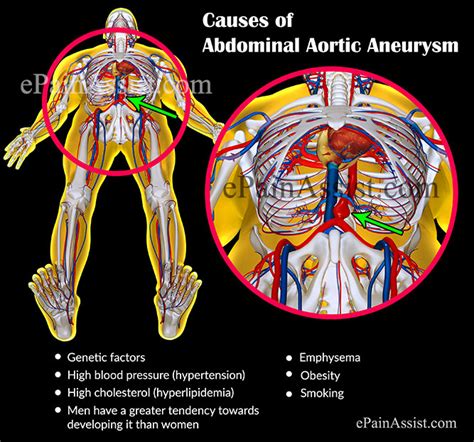 Abdominal Aortic Aneurysm: Treatment, Causes, Symptoms, Signs, Tests