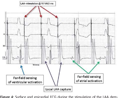 [PDF] Epicardial left atrial appendage clip occlusion also provides the electrical isolation of ...