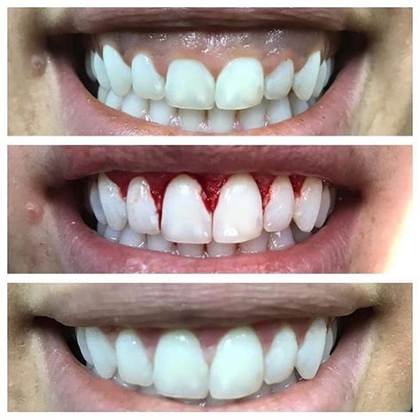 GUM LIFT CASE... here is a another great example how a gum lift can ...