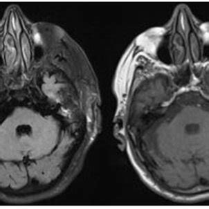 (PDF) Management of Spontaneous Cerebrospinal Fluid Leaks in the Middle Cranial Fossa and Bone ...